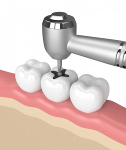 3d render of teeth with dental drill in gums over white